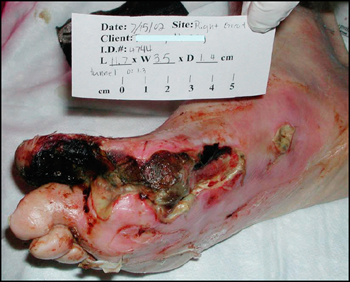 Diabetic Foot Ulcers Treatment