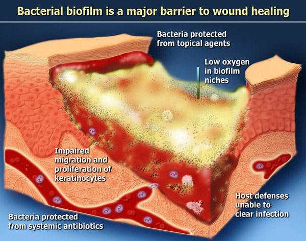 Biofilm barrier to wound healing