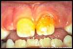 dental plaque